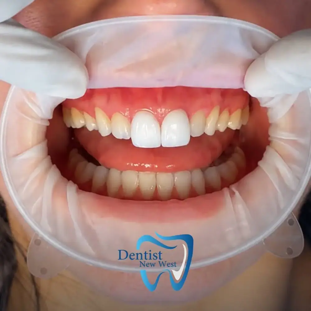 کلینیک دندان پزشکی Dentist New West، عکس 2 از اینستاگرام